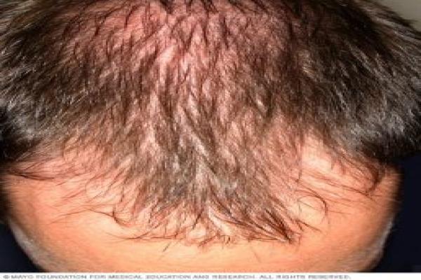 کاملترین مقاله درمان ریزش مو، جلوگیری از ریزش مو و علت ریزش مو