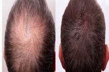 درمان ریزش مو با پی آر پی